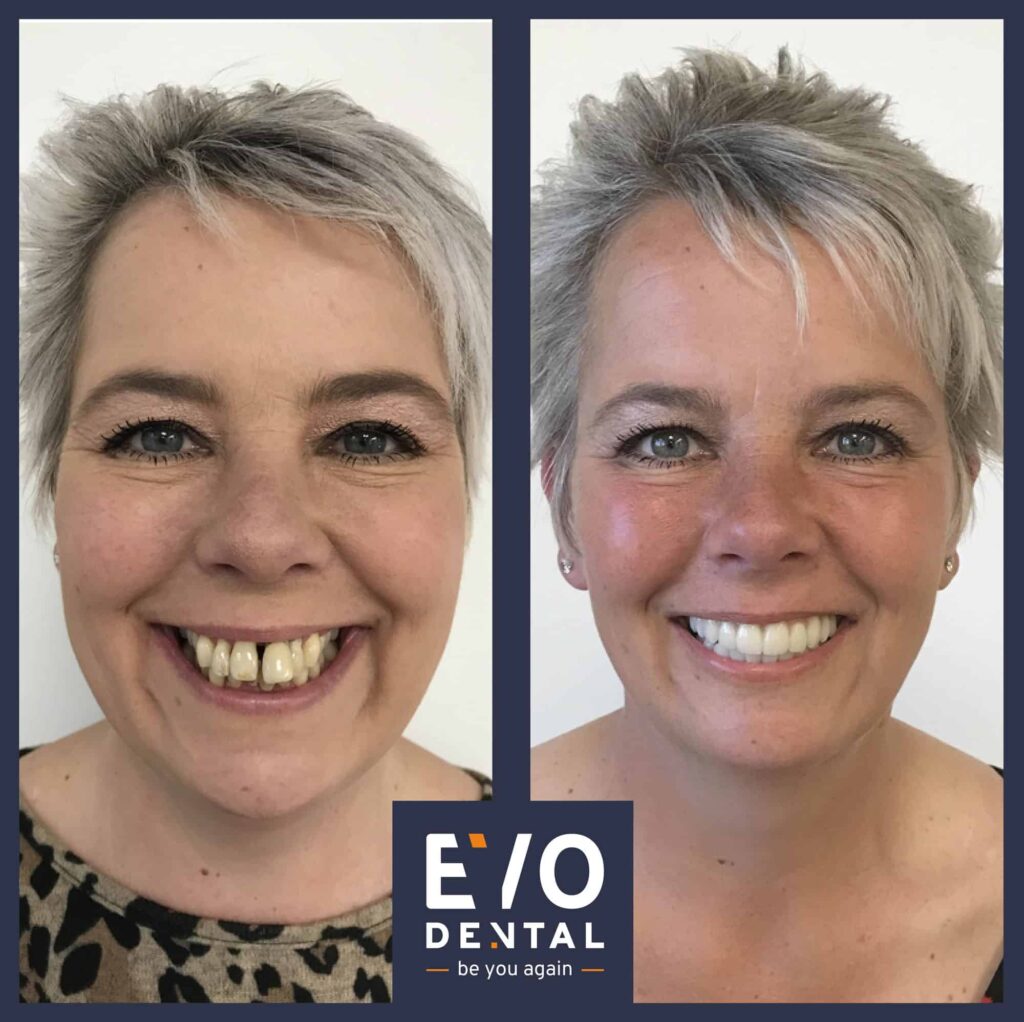 EvoDental before and after - all-on-four