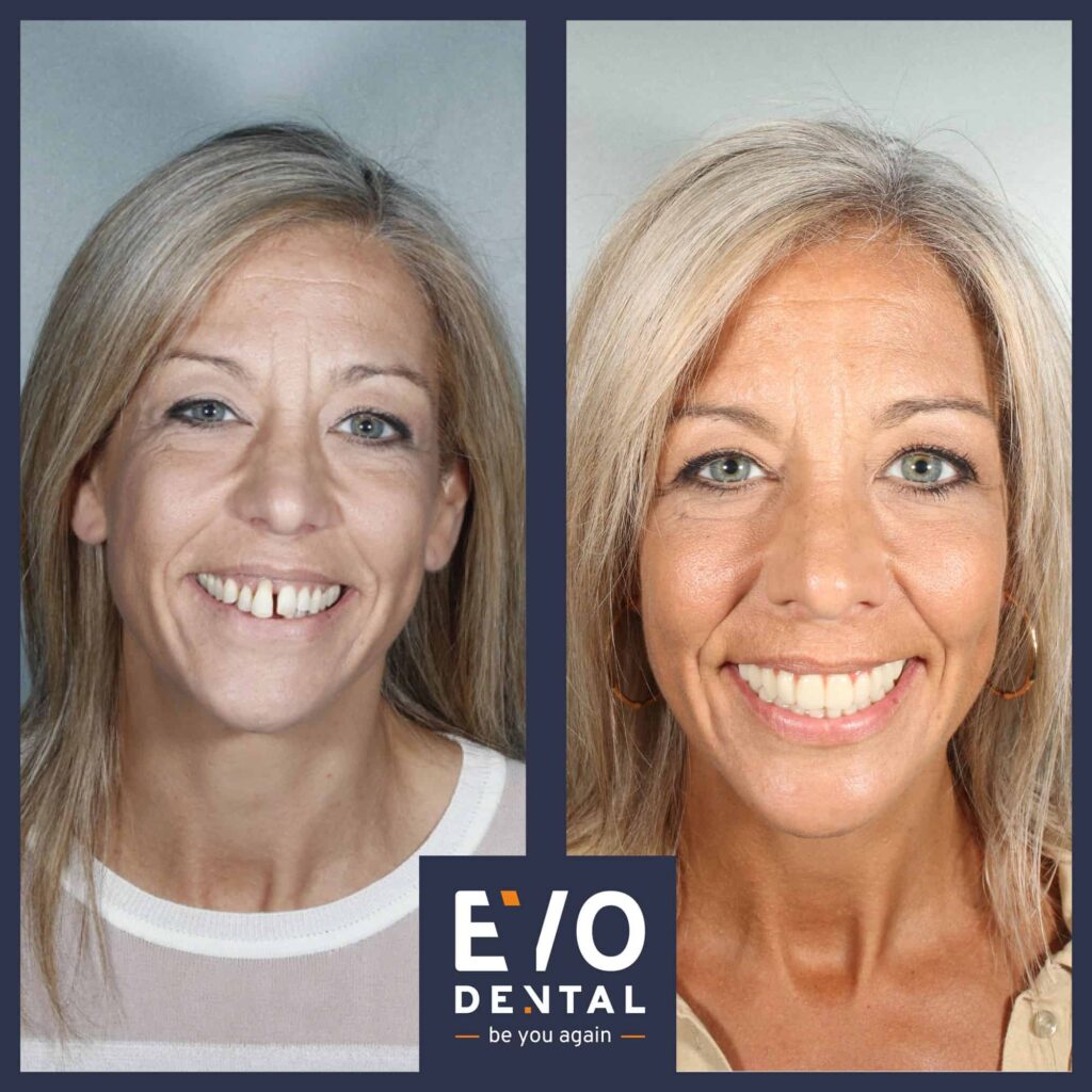 dental implant patient before and after image in Wolverhampton