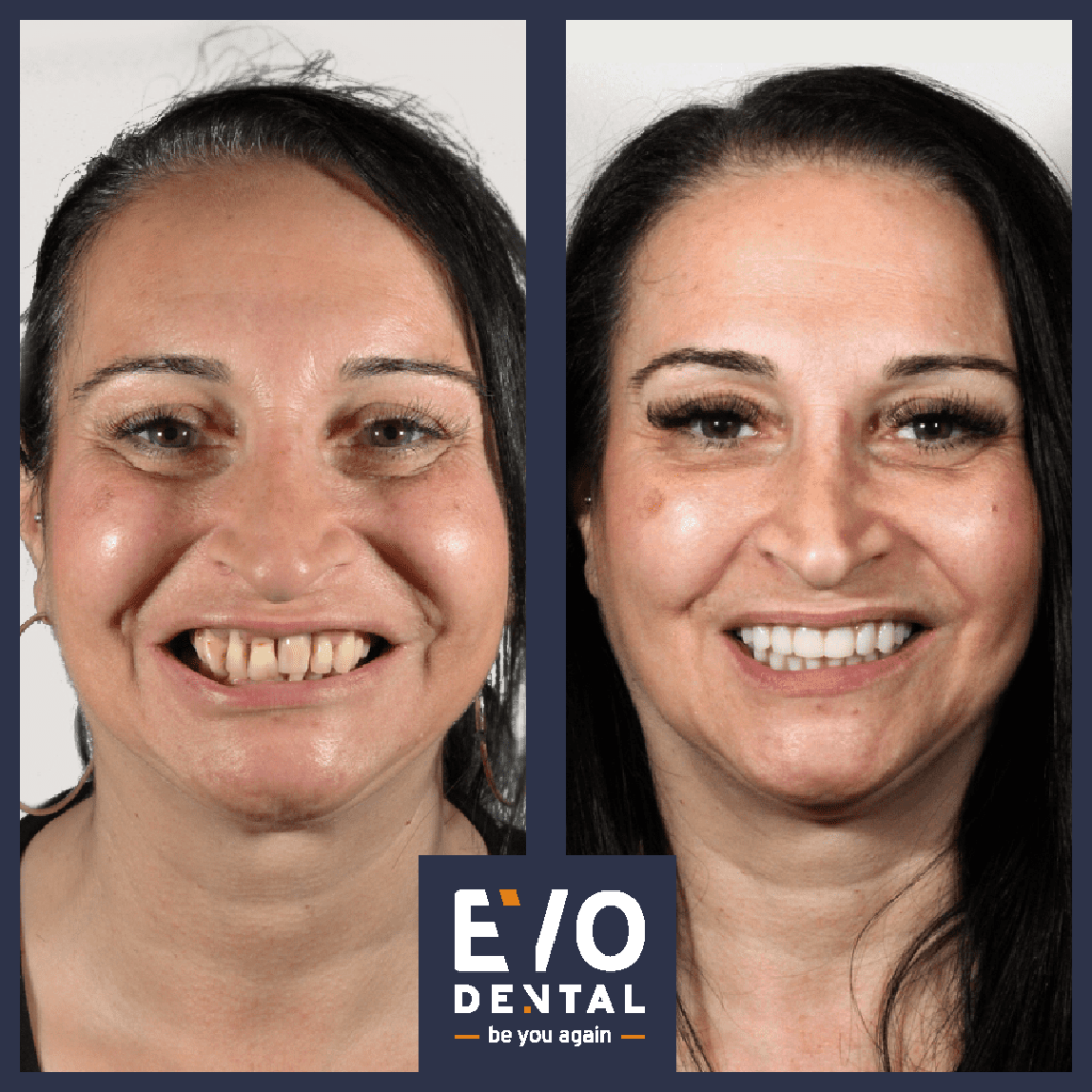 all on four dental implants london patient before and after 1