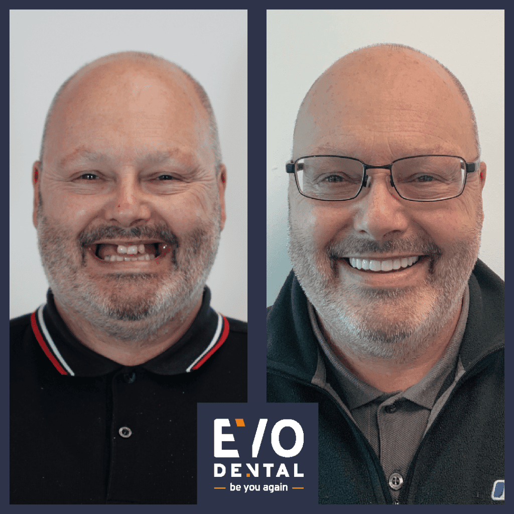 all on four dental implants london patient before and after 3