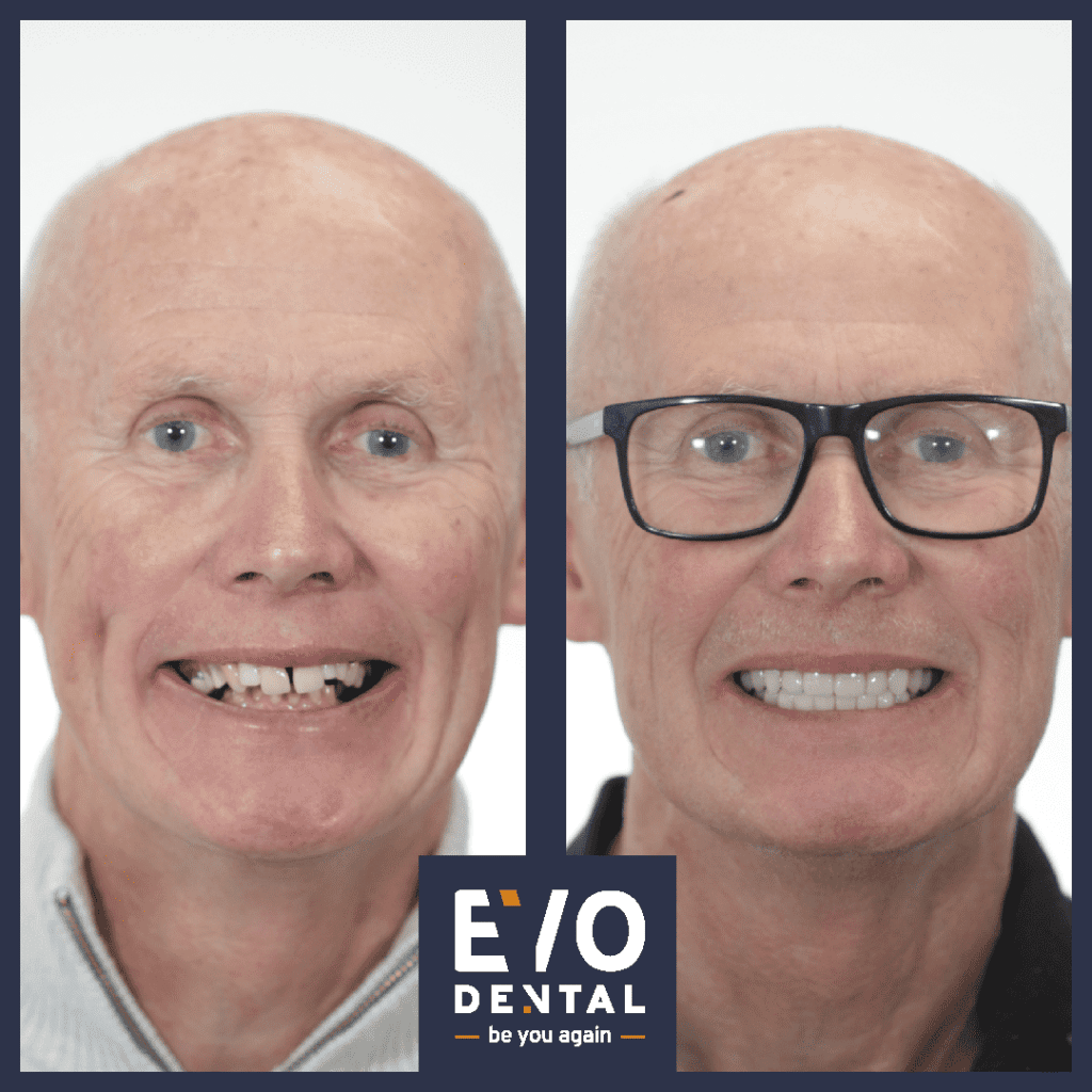 all on four dental implants london patient before and after 6