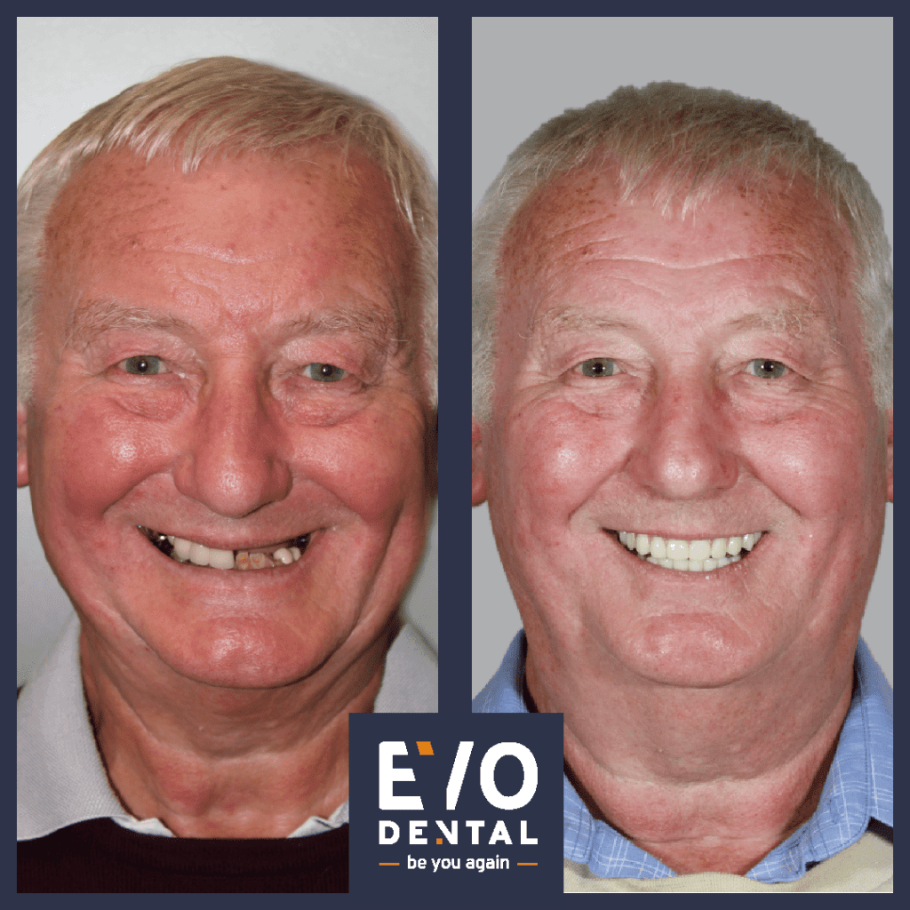 all on four dental implants manchester patient before and after 4