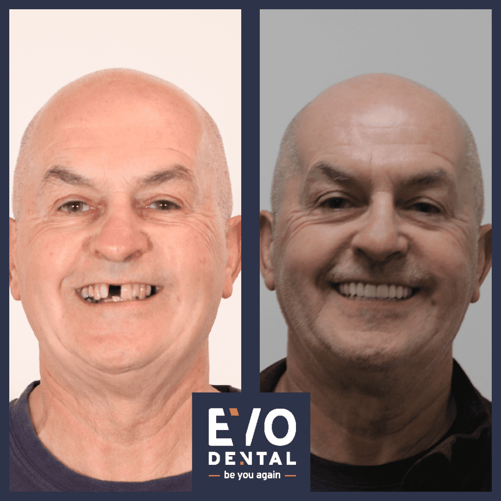 all on four dental implants manchester patient before and after 5