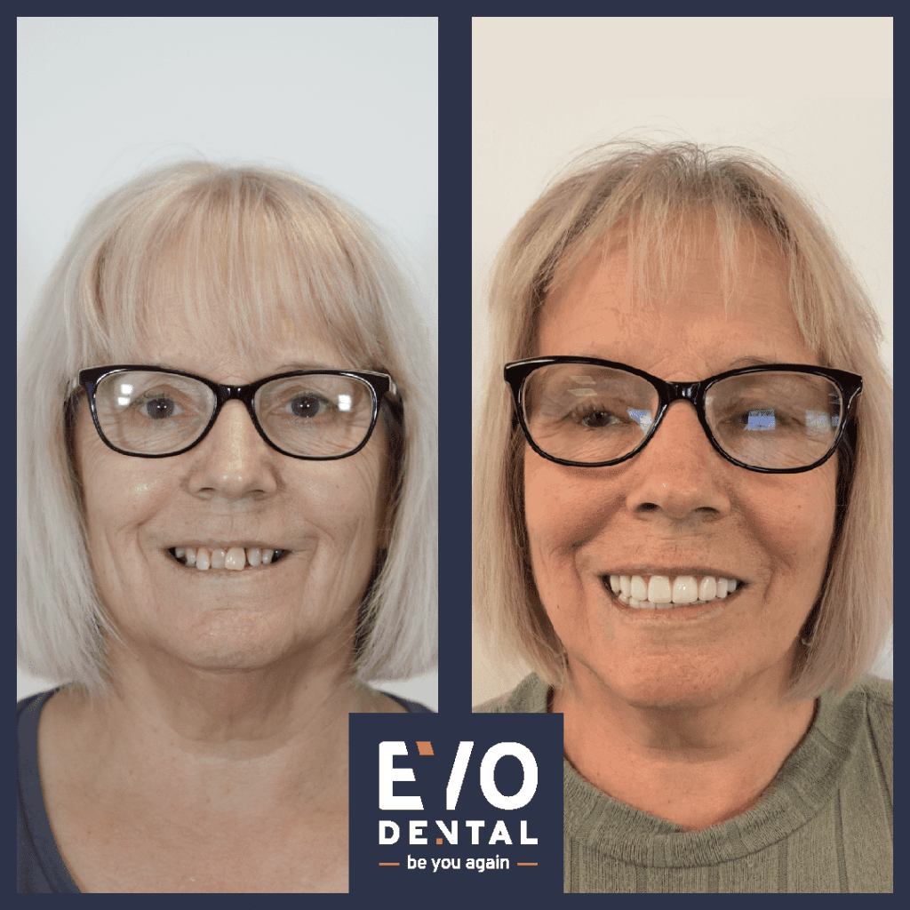 all on four dental implants solihull before and after image 1