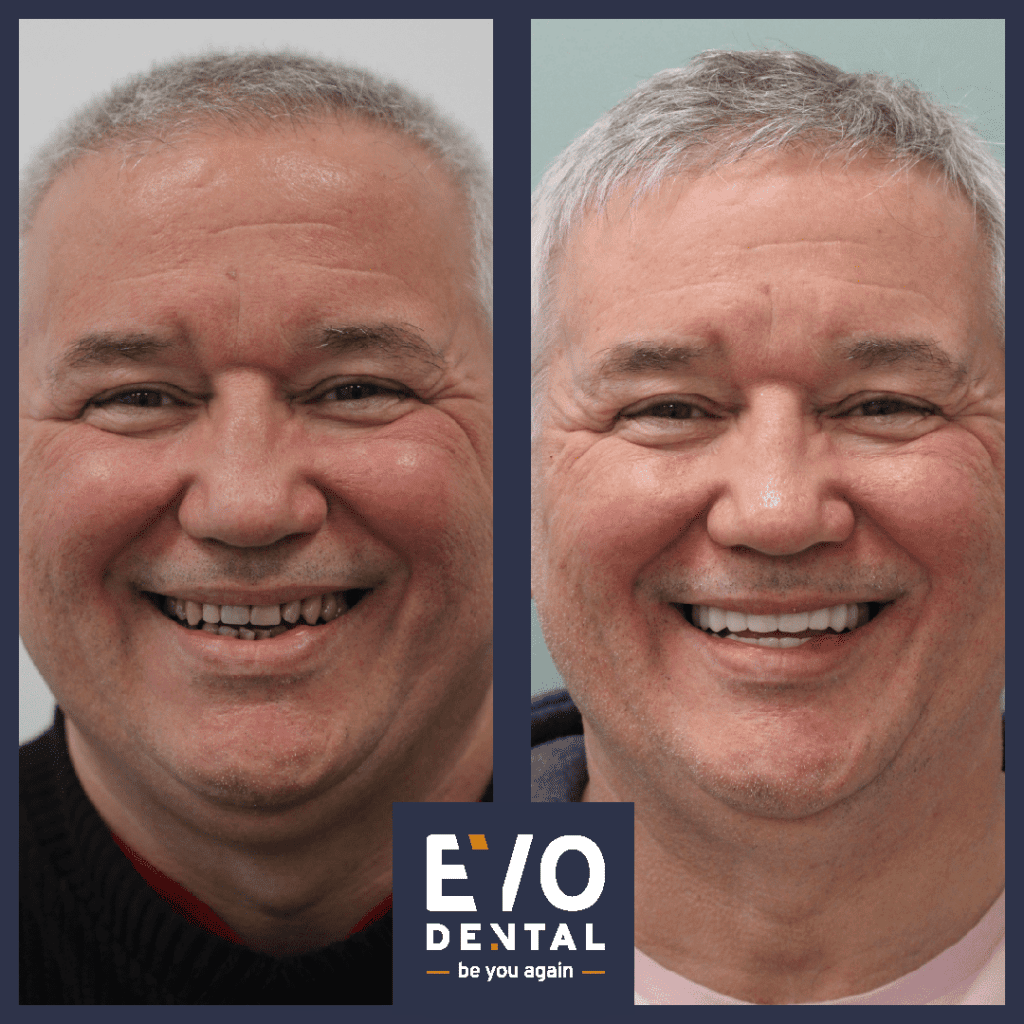 full jaw dental implants manchester patient before and after 3