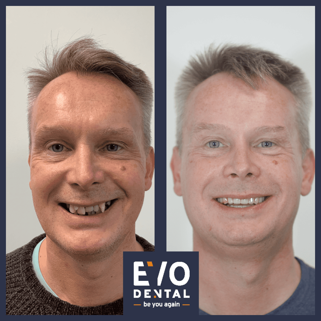 full jaw dental implants manchester patient before and after 4