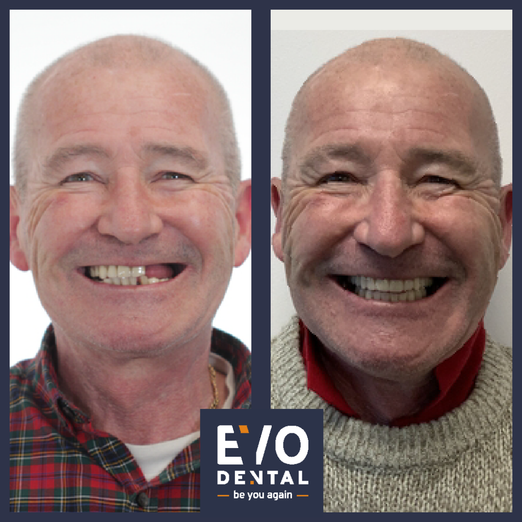 smile in a day solihull patient before and after 5