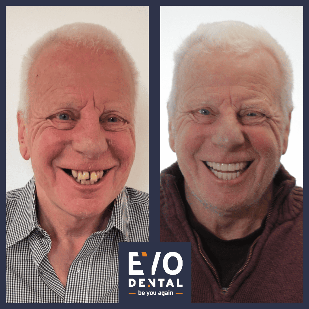 denture alternatives wolverhampton 4