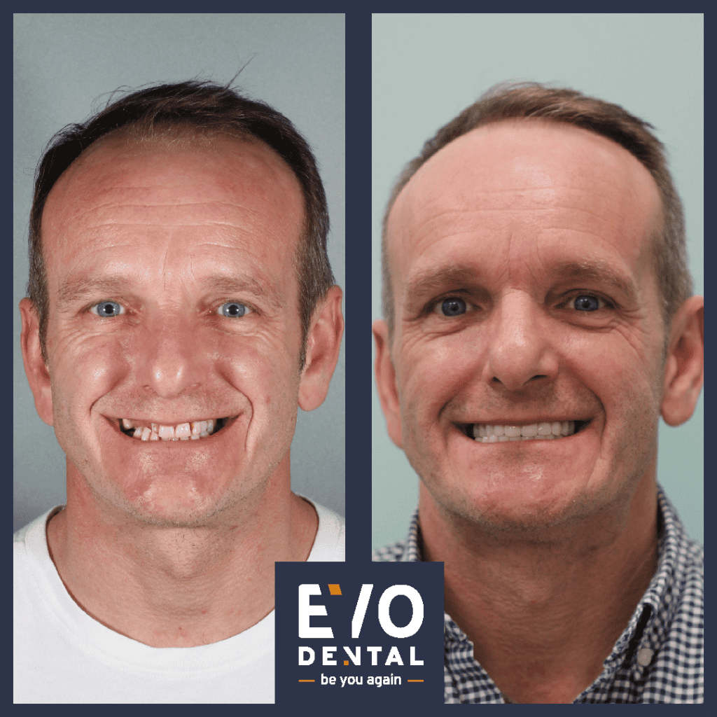 denture alternatives wolverhampton 5