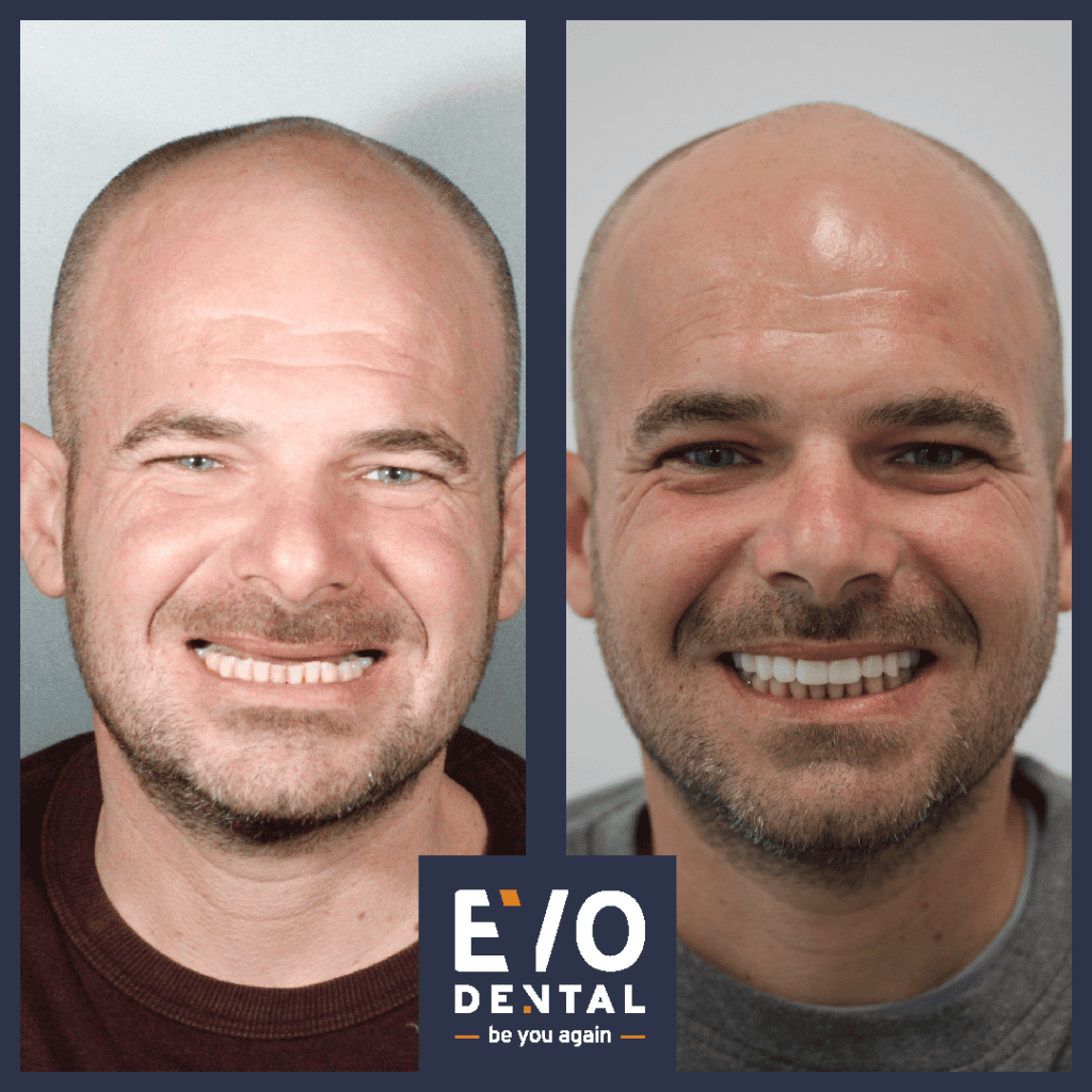 full mouth dental implants leeds 1