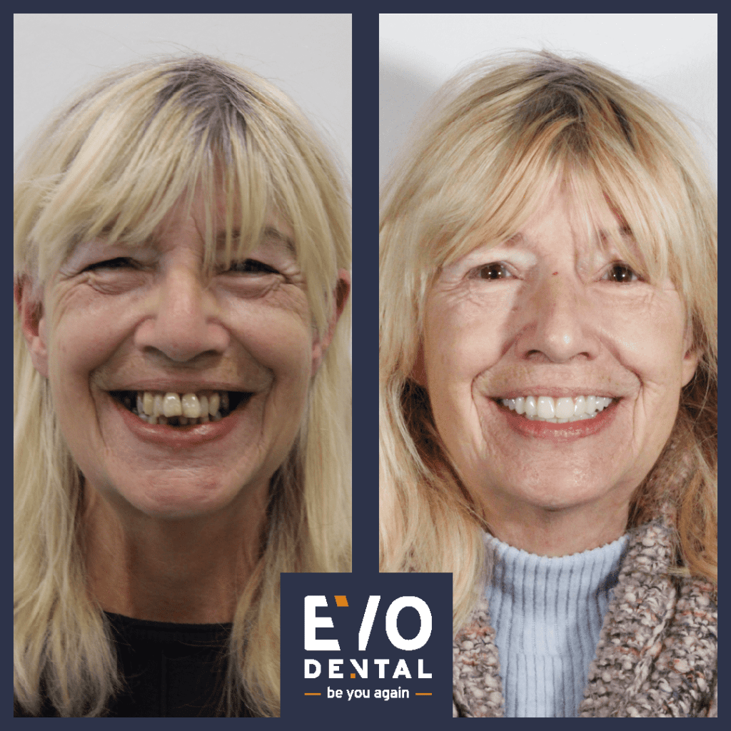 full mouth dental implants leeds 3