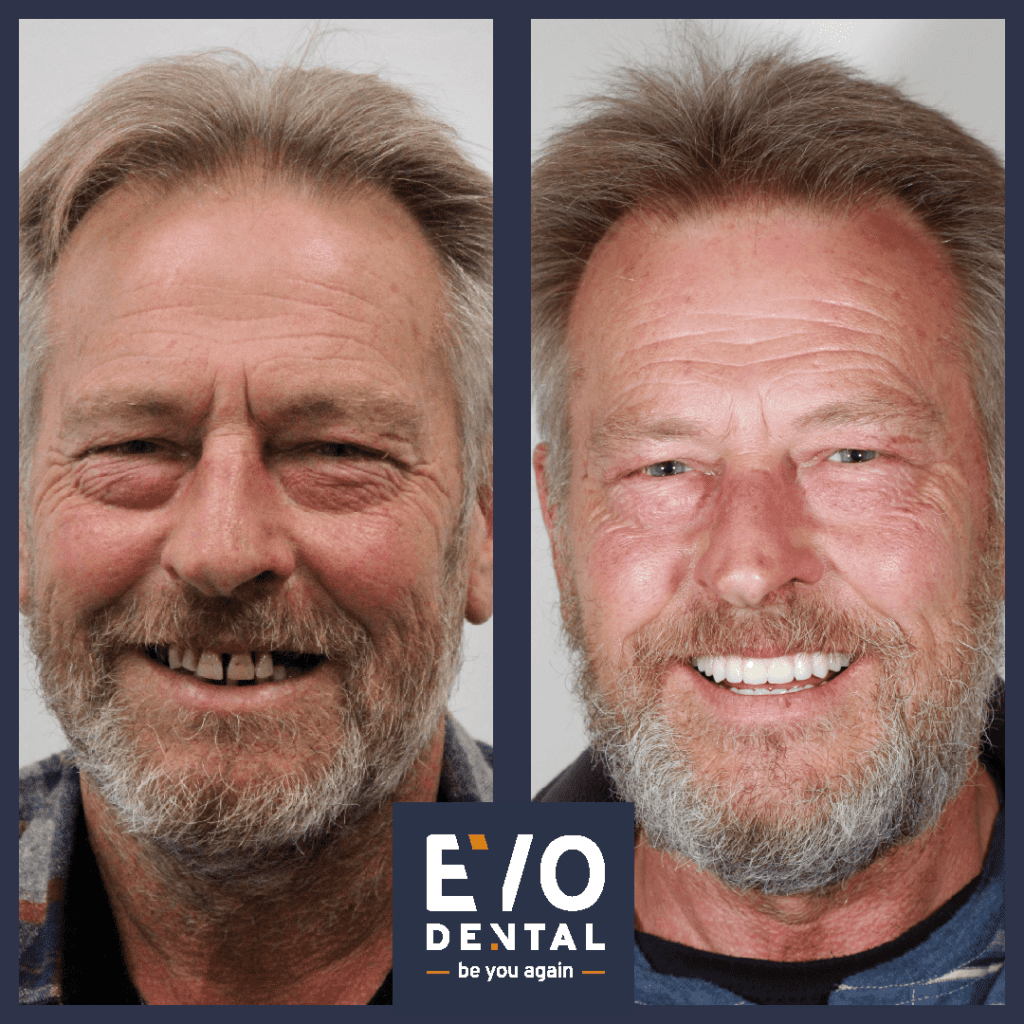 full mouth dental implants leeds 5