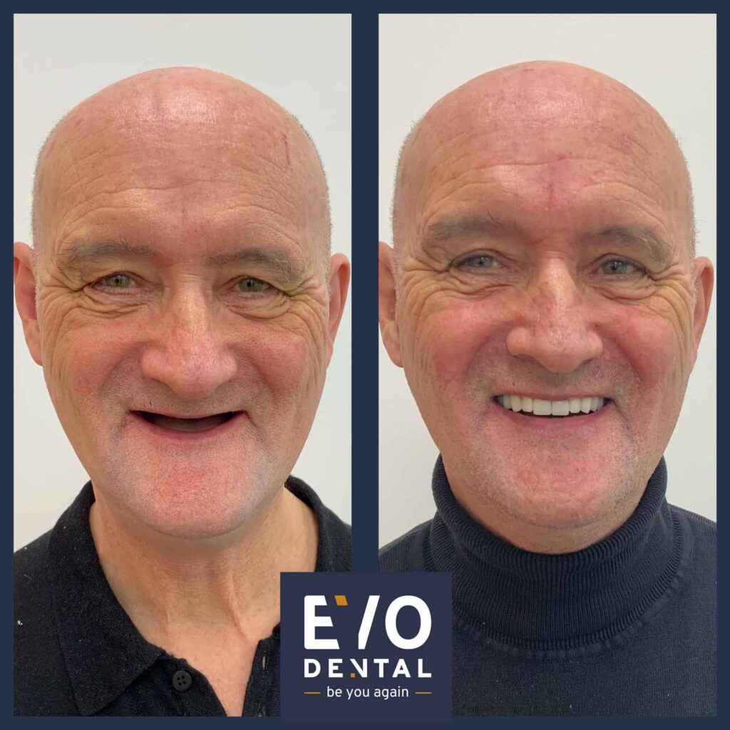 Dental Implants in York - EvoDental