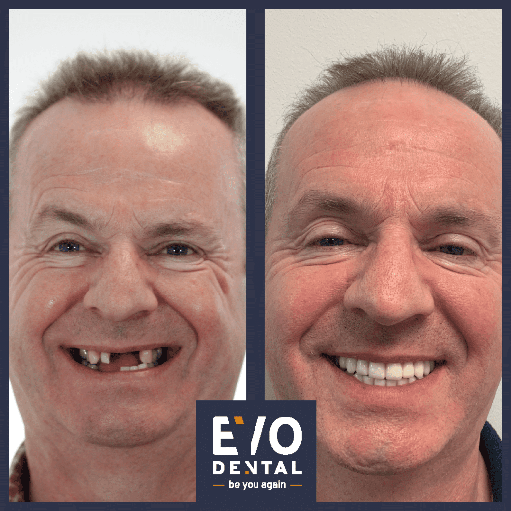 dental implants dartford