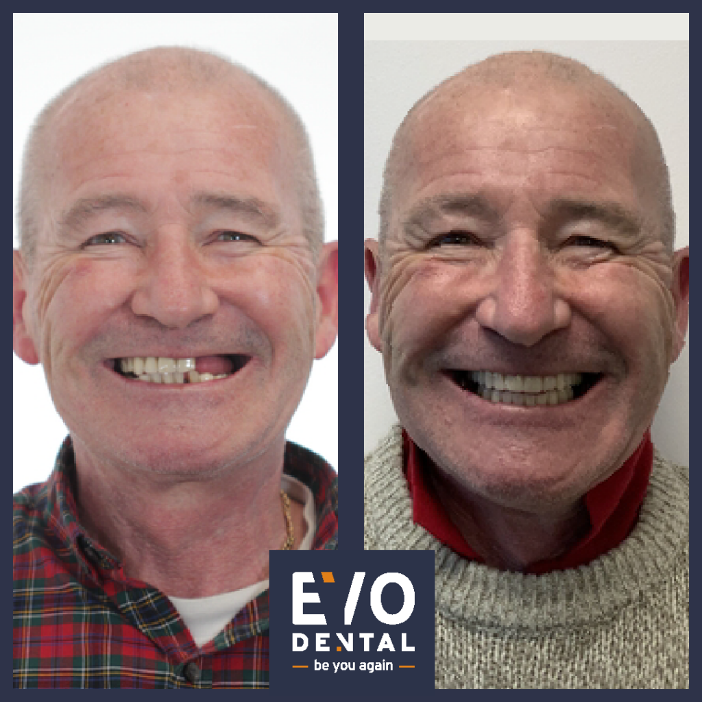 Dental Implants Medway - EvoDental