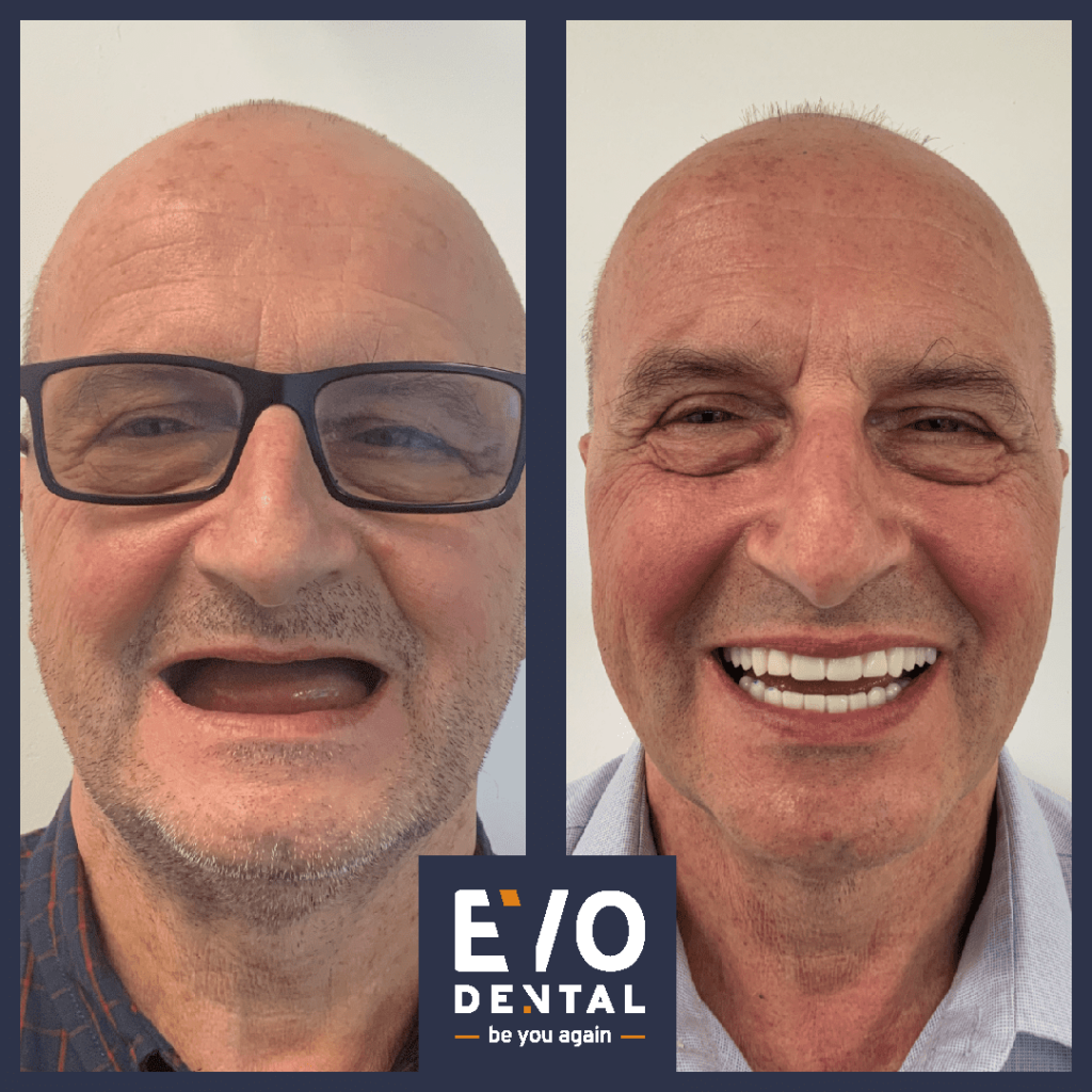 Dental Implants Medway - EvoDental