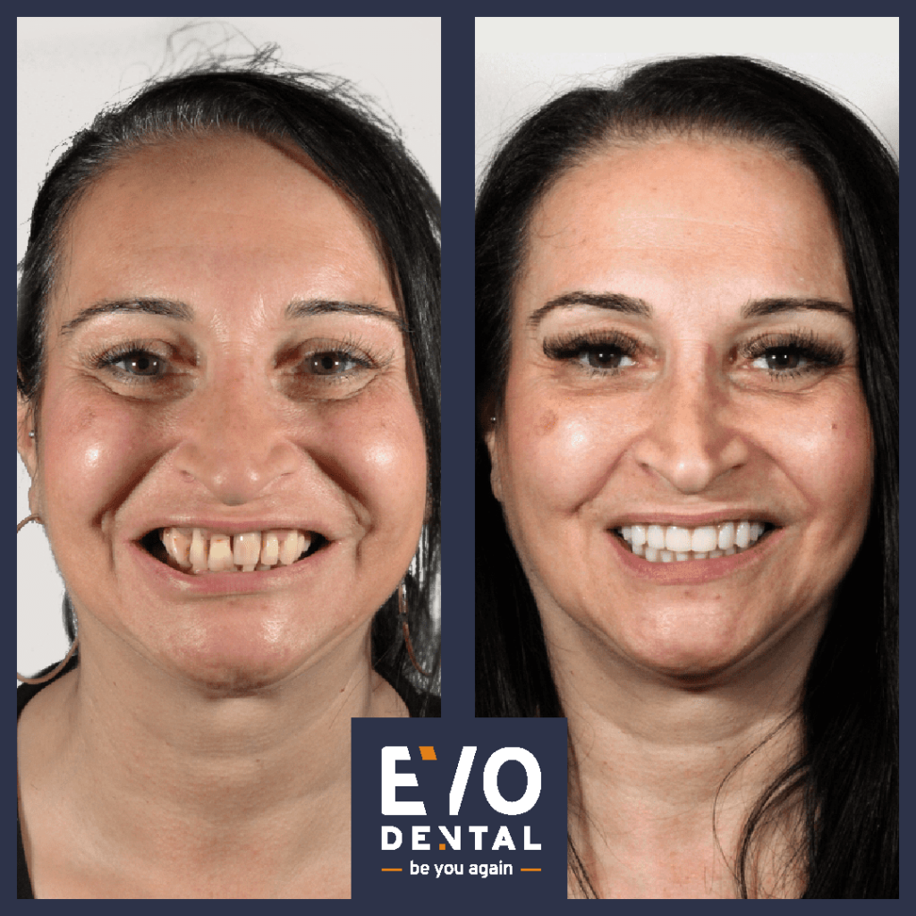 Leading Provider of Dental Implants in Barnsley