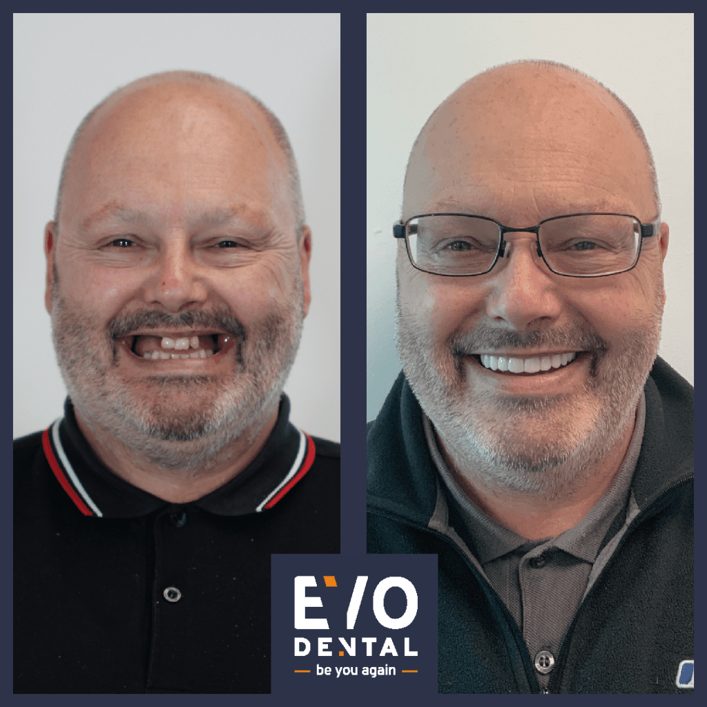 Before & After Dental Implants in Bristol