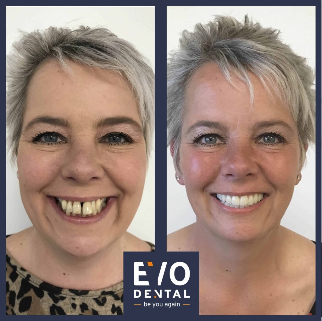 Cardiff Dental Implants - EvoDental