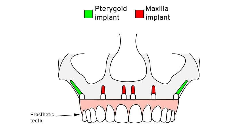 pterygoid-dental-implants