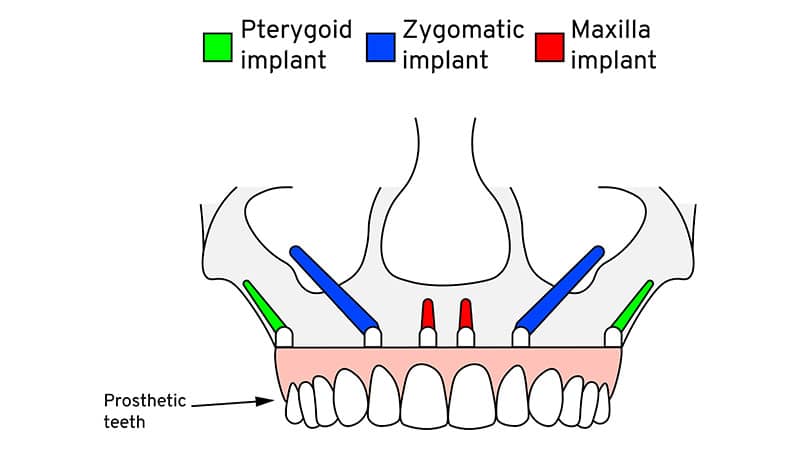 zygomatic dental implant