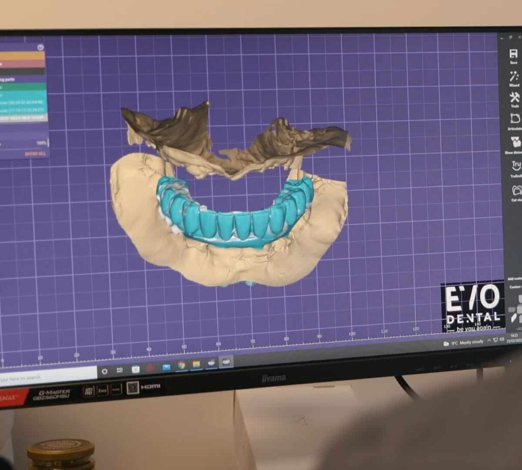 Evo Dental Implant scan