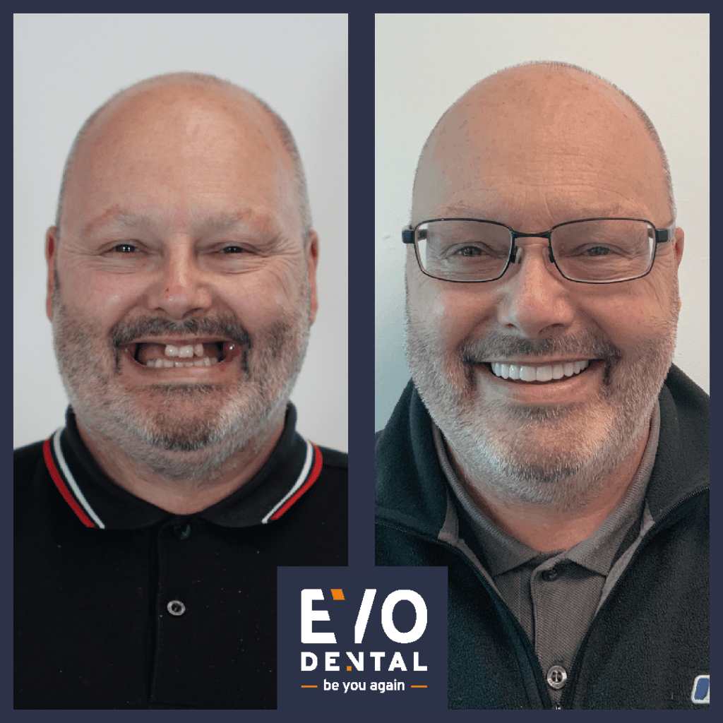 dental implants edinburgh before and after