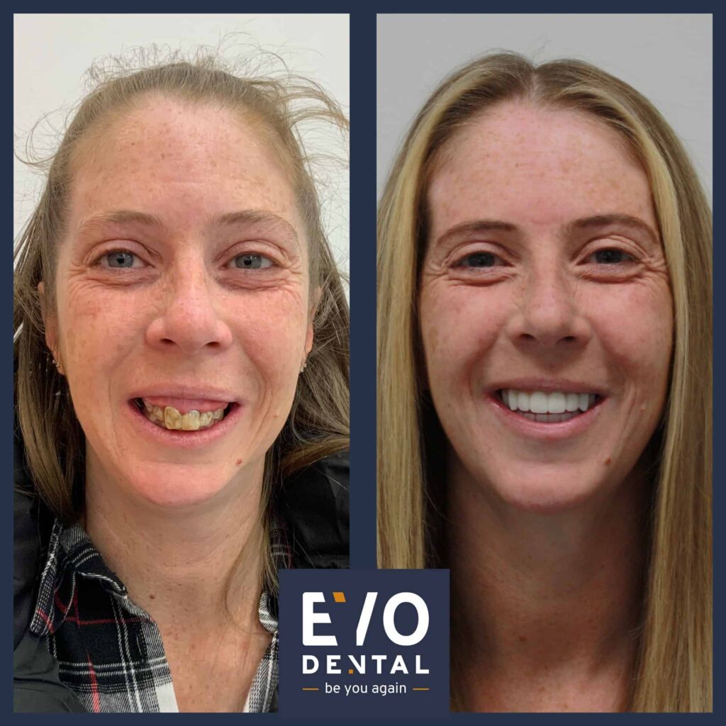 dental implants edinburgh before and after 5