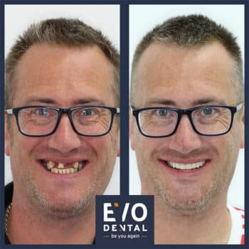 Before & After Dental Implants in Glasgow