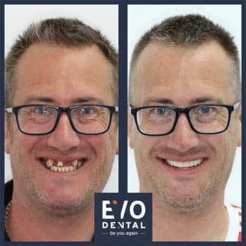 Dental Implants before and after at Evo Dental male