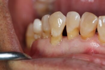 Periodontitis - Everything you need to know about gum disease