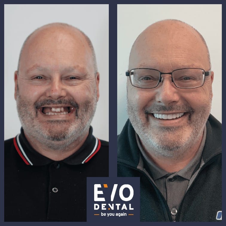 before and after all on 4 dental implants 2